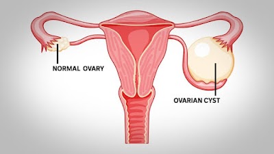 Dr Priya Agarwal best Gynaecologist east Delhi, lady specialist in east delhi, gynae doctor in east delhi - Image 2