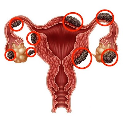 Dr Priya Agarwal best Gynaecologist east Delhi, lady specialist in east delhi, gynae doctor in east delhi - Image 3