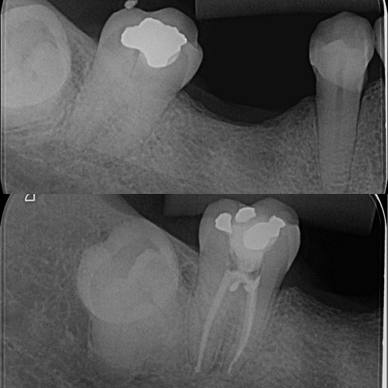 Dentista 24Horas - Dr Lucas Eduardo - Tratamento de Canal - Limpeza - Clareamento - Extração. - foto 2