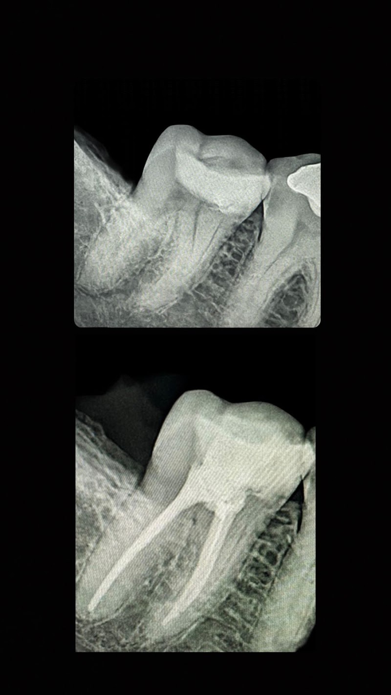 Dentista 24Horas - Dr Lucas Eduardo - Tratamento de Canal - Limpeza - Clareamento - Extração. - foto 5