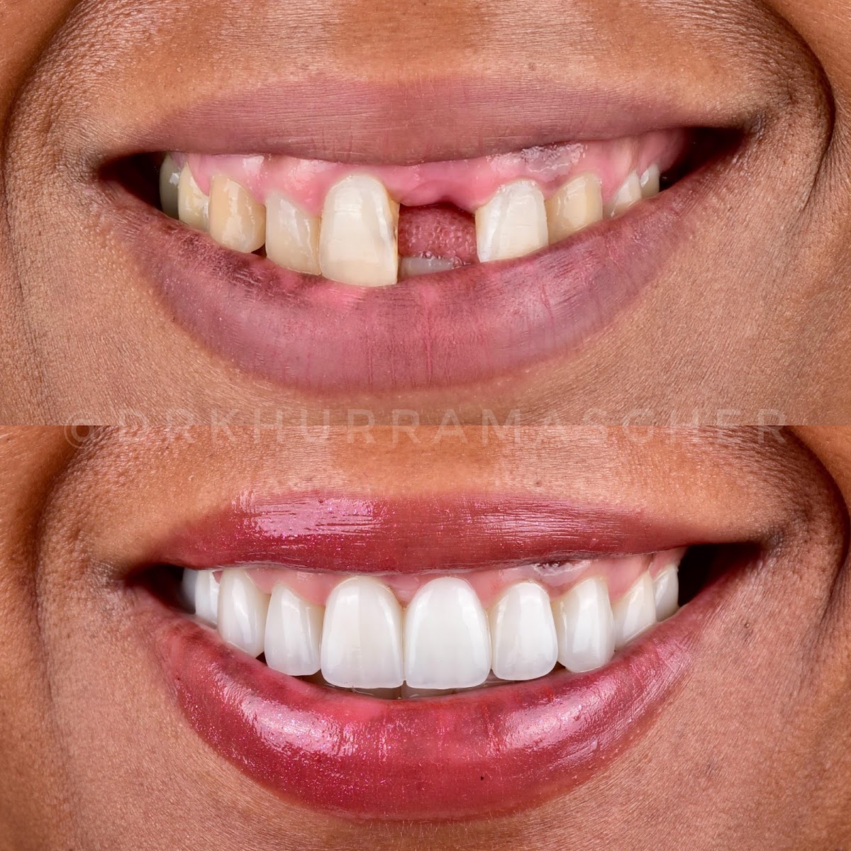 The Smile Collective (Dentist) by Dr. Khurram Asgher DDS (USA) 2