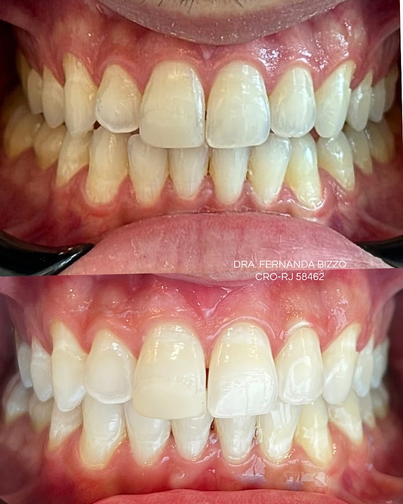 Dentista em São Gonçalo | Dra. Fernanda Bizzo | Clareamento e Prótese Dentária - foto 5