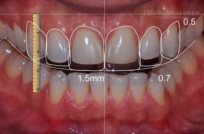 Implantes Dentários - Dr Felipe Schonrock - foto 5