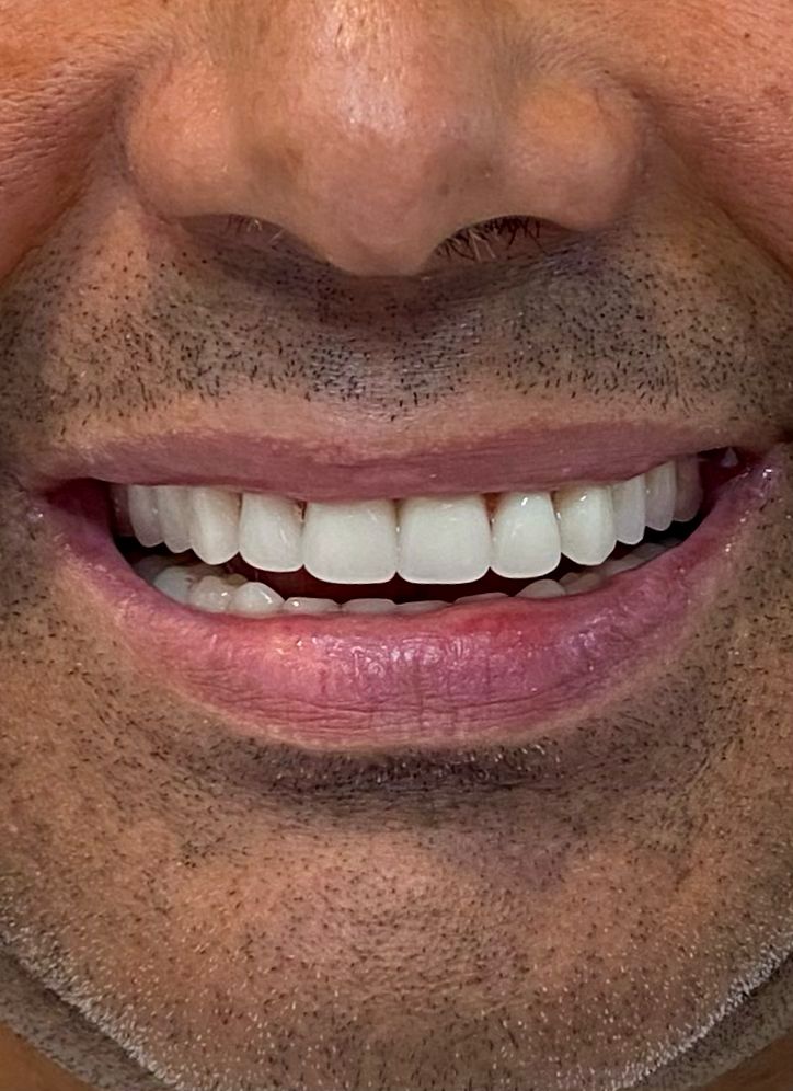 Implantes Dentários - Dr Felipe Schonrock - foto 2