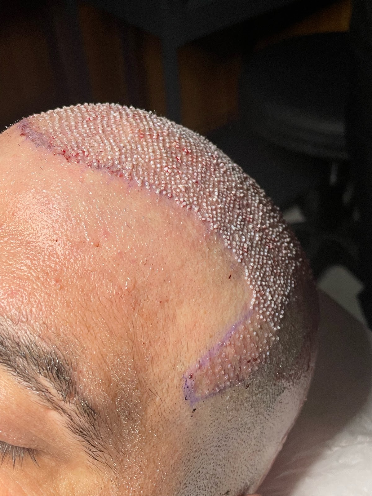 The Best Hair Transplant - FUE Maximum Graft in 1 Day Dubai Clinic / SBL Health 5
