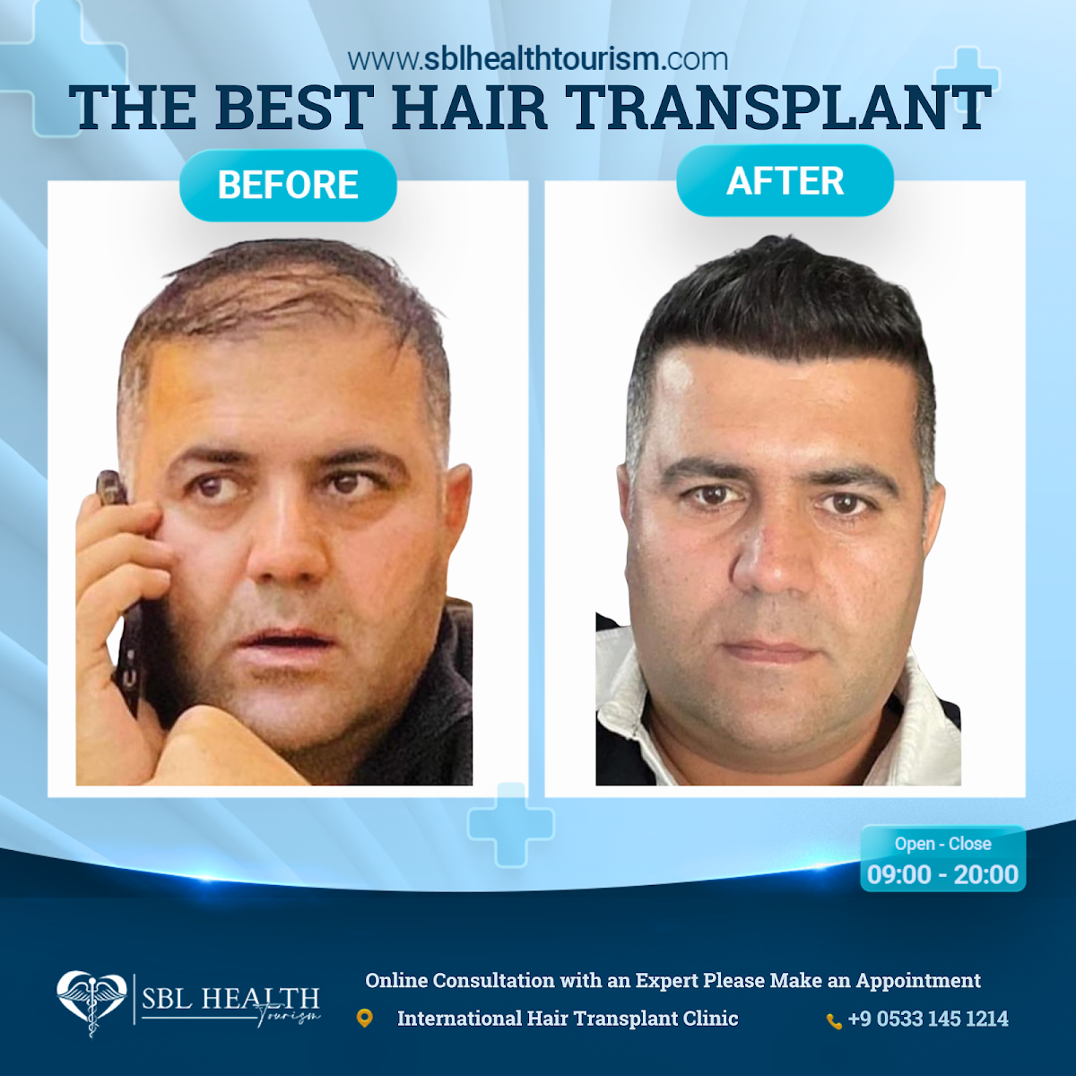 The Best Hair Transplant - FUE Maximum Graft in 1 Day Dubai Clinic / SBL Health 4