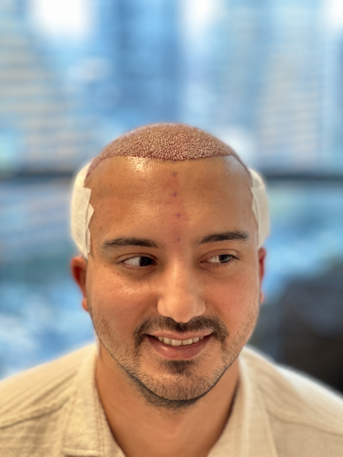 The Best Hair Transplant - FUE Maximum Graft in 1 Day Dubai Clinic / SBL Health