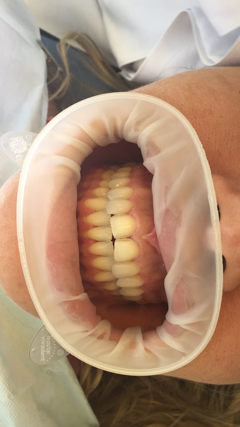 Faces Odontologia Especializada - Lentes de Contato Dental - foto 3