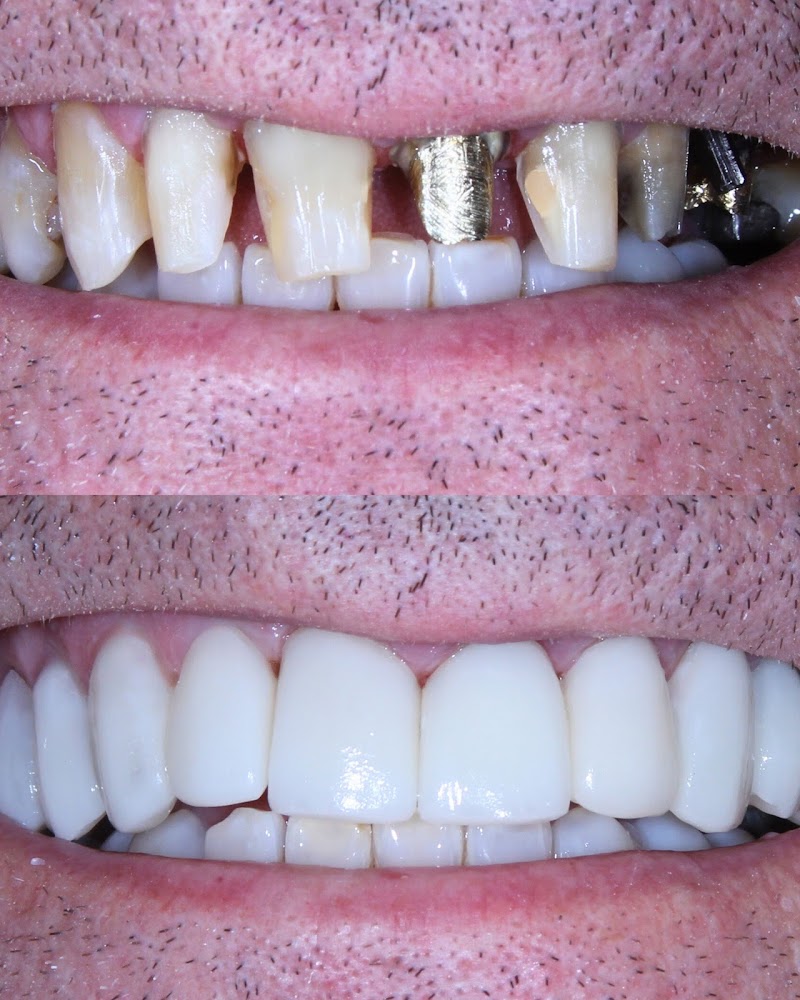 Onne Odontologia | Dentista Águas Claras | Implante Dentário Aparelho Invisível Invisalign - foto 4