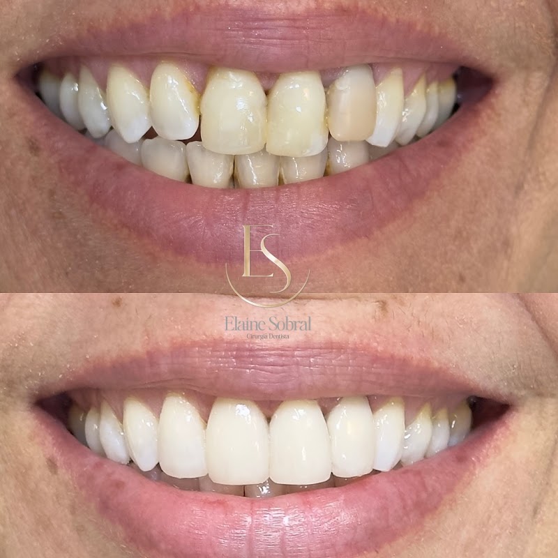 Dra. Elaine Sobral Leite Dentista | Alinhadores Invisíveis | Implantes Dentários Maceió - foto 3