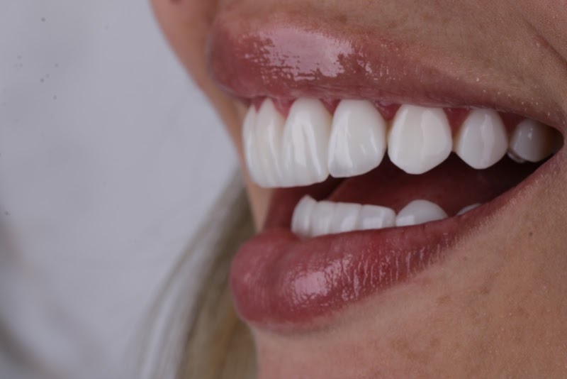 Dra. Caroline Tigre • Lentes em resina & Porcelana - foto 1