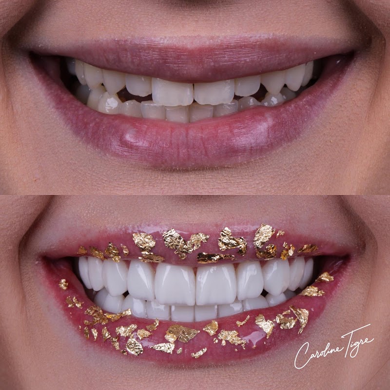 Dra. Caroline Tigre • Lentes em resina & Porcelana - foto 2