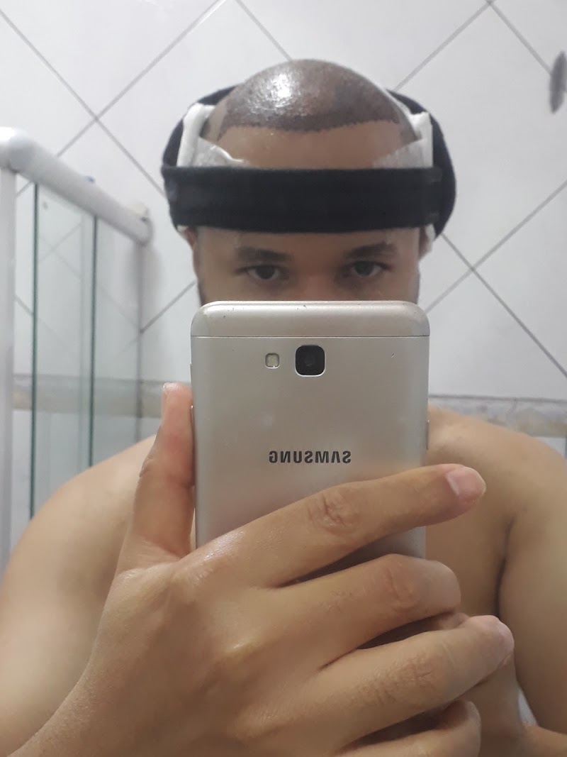 Clínica Matarazzo Transplante Capilar RJ - foto 4