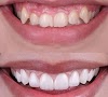 NÜVA Smile