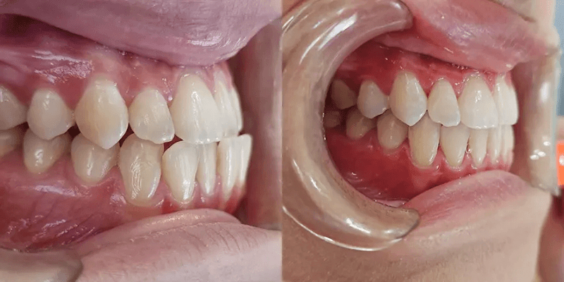 Dra Alessandra Praun | Alinhadores Invisíveis SouSmile | Clareamento Dental SEM DOR | Taquara/RJ - foto 4
