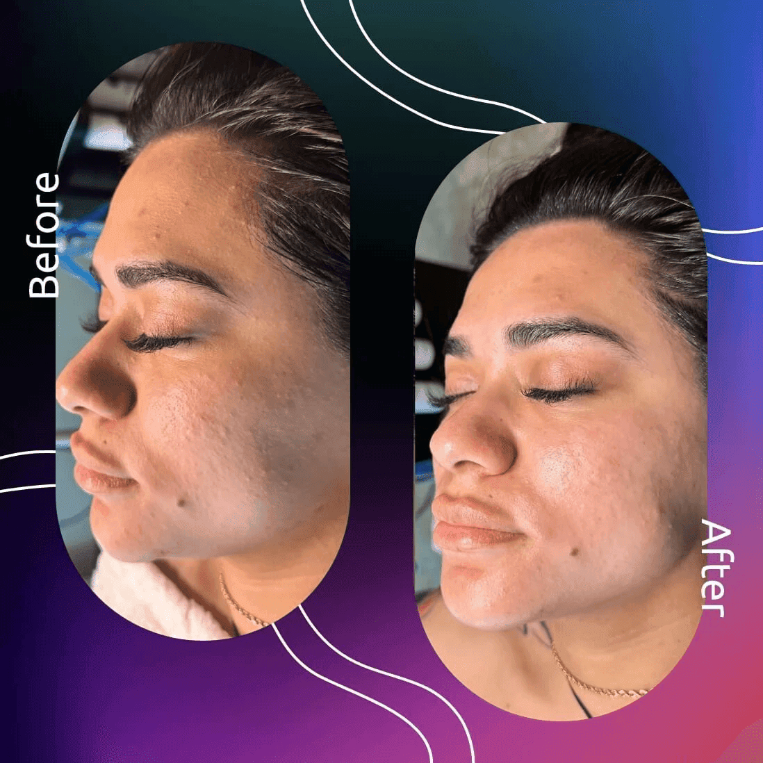 Novomed Lasers and Facials Clinic - Dubai Marina Laser Hair Removal | Hydrafacial | Carbon Peel 5