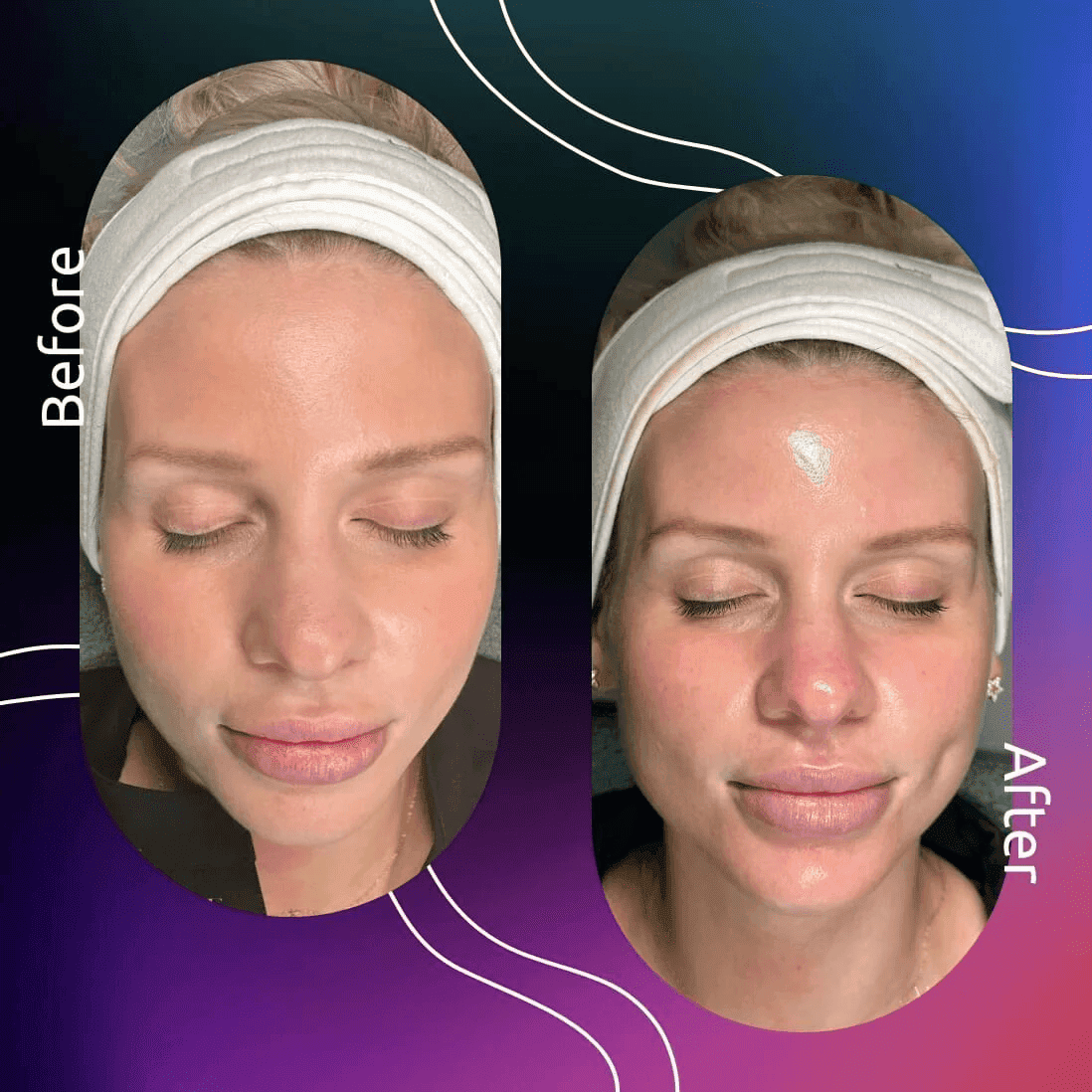 Novomed Lasers and Facials Clinic - Dubai Marina Laser Hair Removal | Hydrafacial | Carbon Peel 3