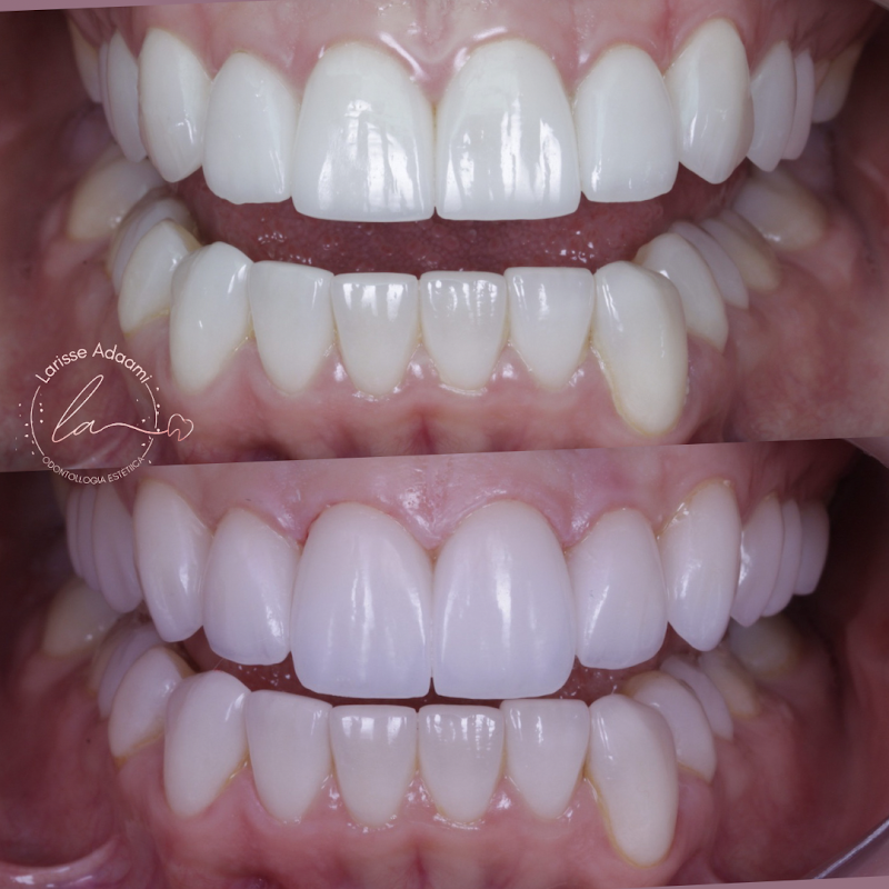 Dra Larisse Adaami Odontollogia Estètiica - Lentes de contato dental, facetas de resina, clareamento, limpeza. - foto 2