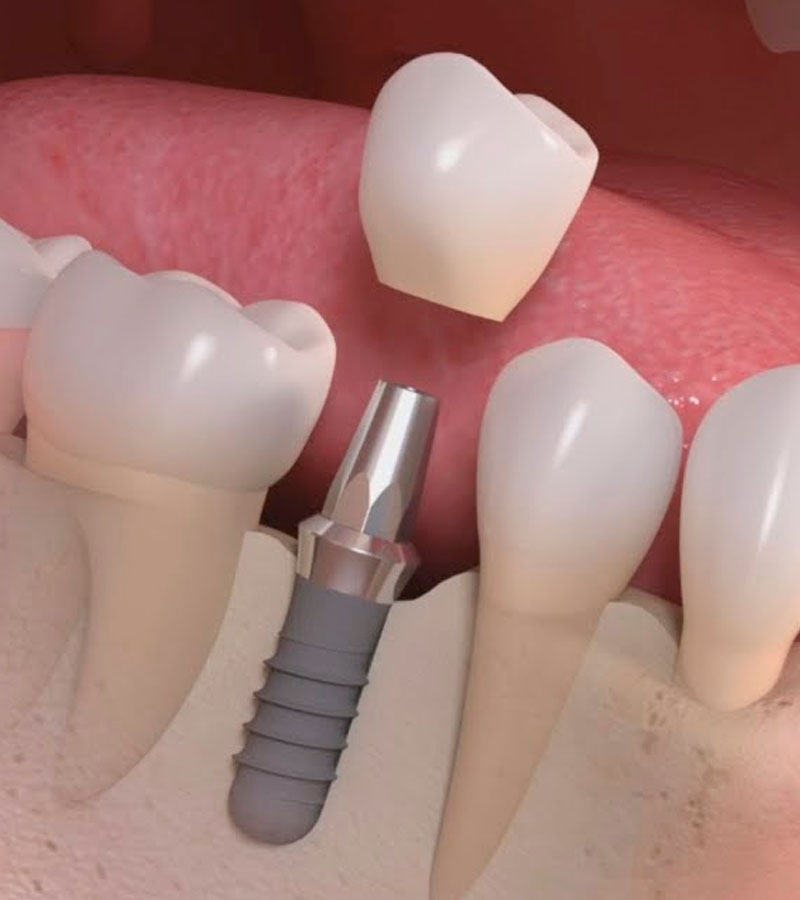 IR Implante Rio - foto 1