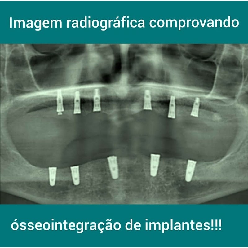 Implante Dentário Salvador - foto 4