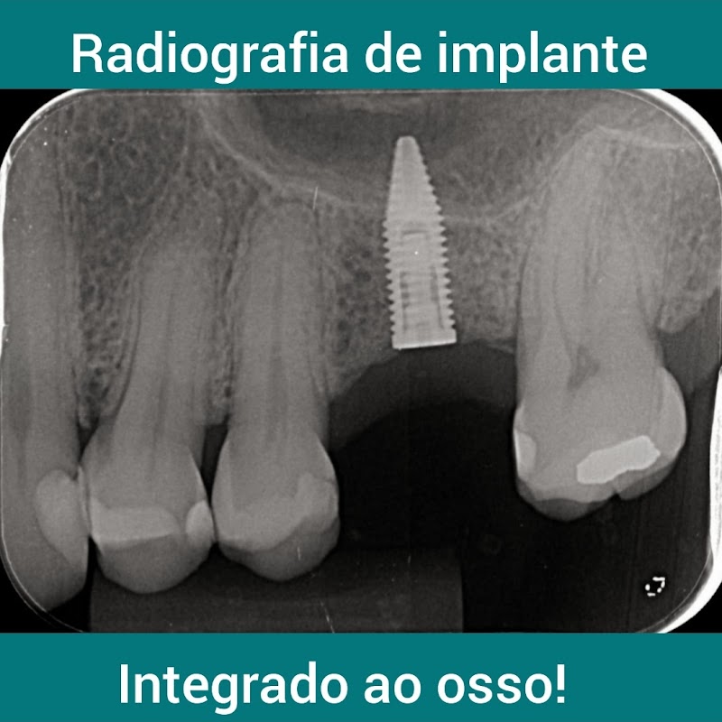 Implante Dentário Salvador - foto 3