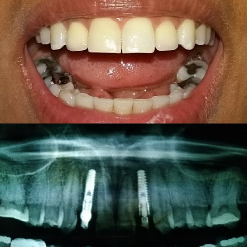Implante Dentário Salvador - foto 2