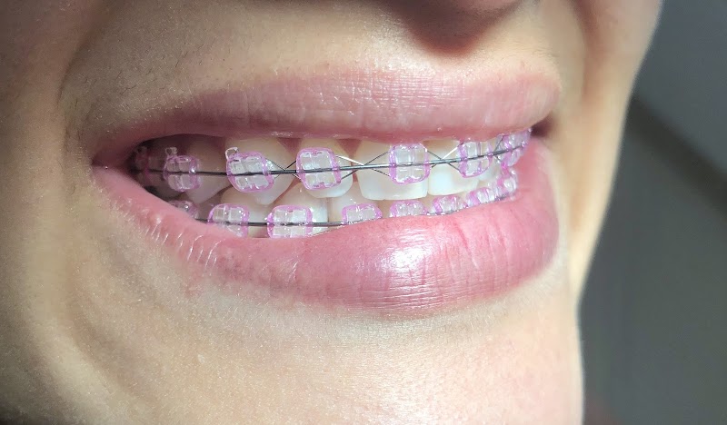 Dra Carol Soares | Aparelho invisível Invisalign em Porto Velho RO - foto 5