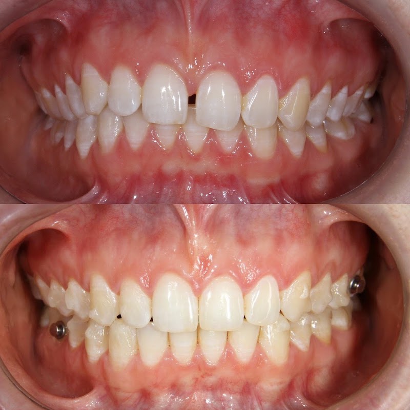 Ortoestética Odontologia Invisalign