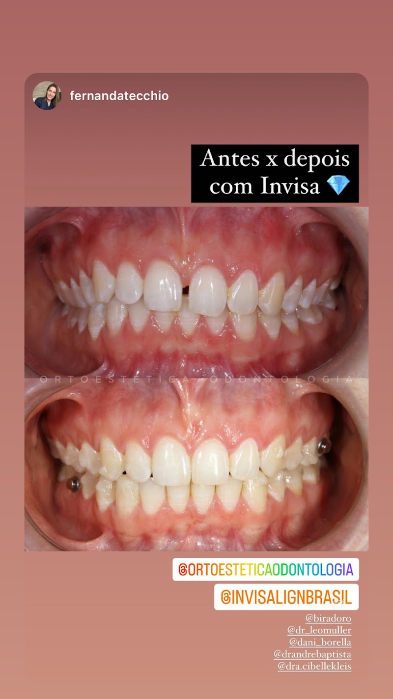 Ortoestética Odontologia Invisalign - foto 2
