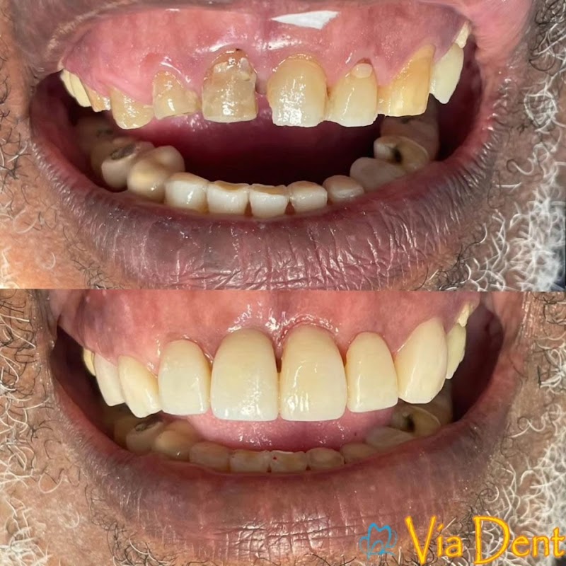 Via Dent Alcântara Implante Dentário