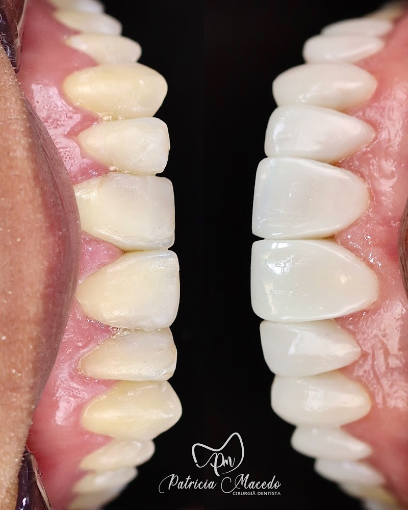 Dra. Patrícia Macedo - Lentes e Facetas de Resina | Recife-PE - foto 2