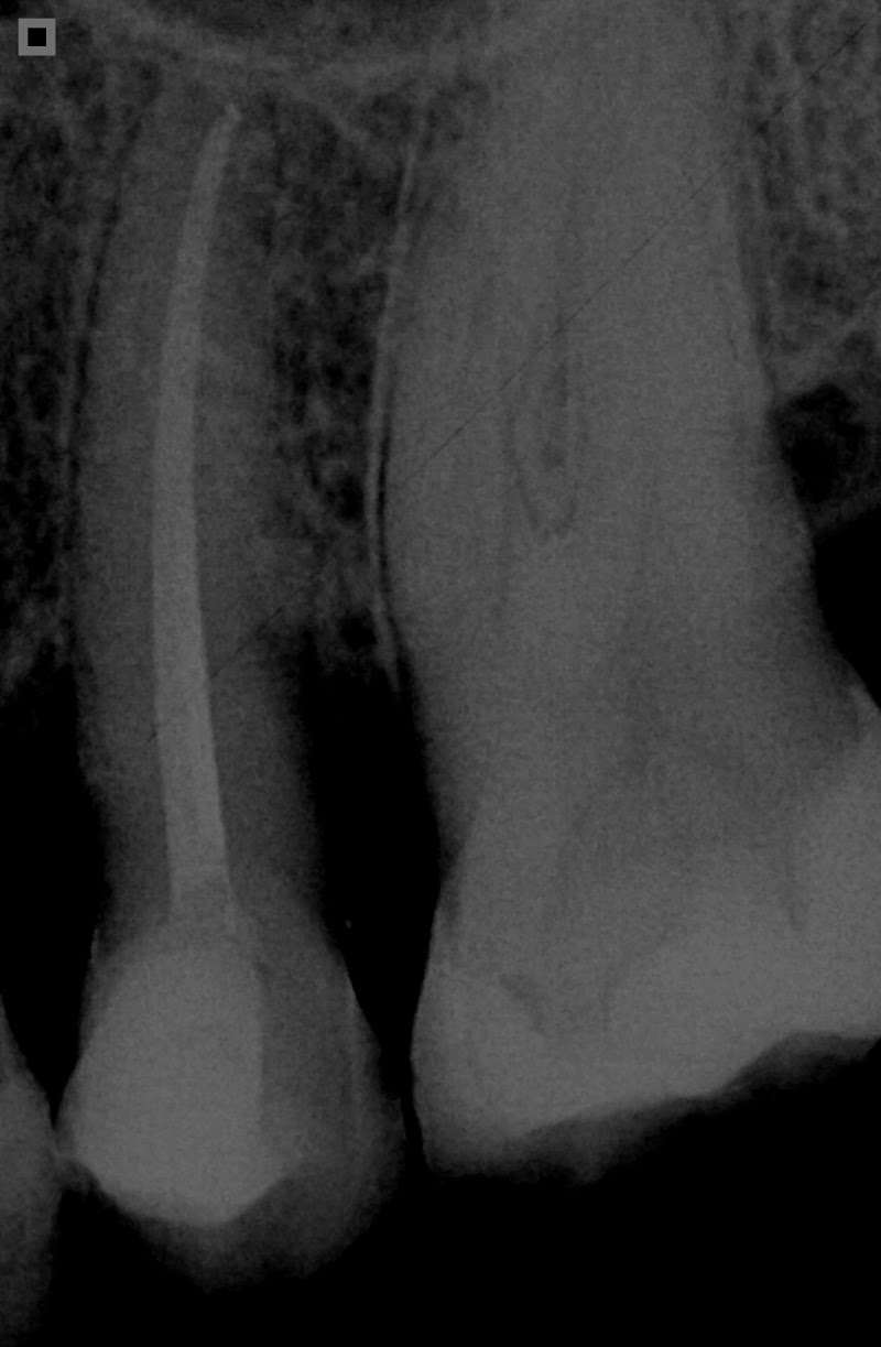Dra. Ana Célia Moura - Endodontia (Tratamento de canal) Especializada em Recife - foto 4
