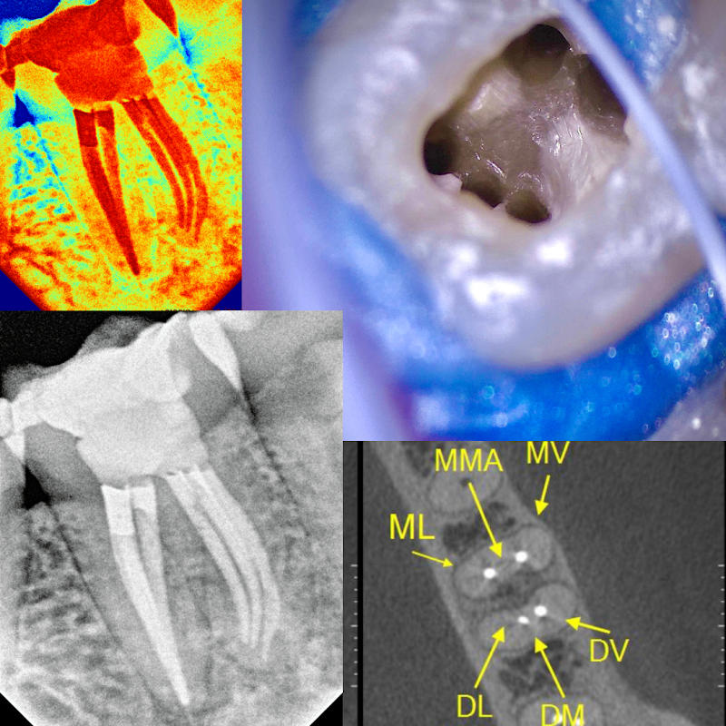 Dr Saulo Revoredo Microscopia - Tratamento de Canal com Microscópio em Brasília - foto 2
