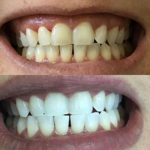 Endodontia - Dentista Especialista Tratamento Canal Metilife - foto 5