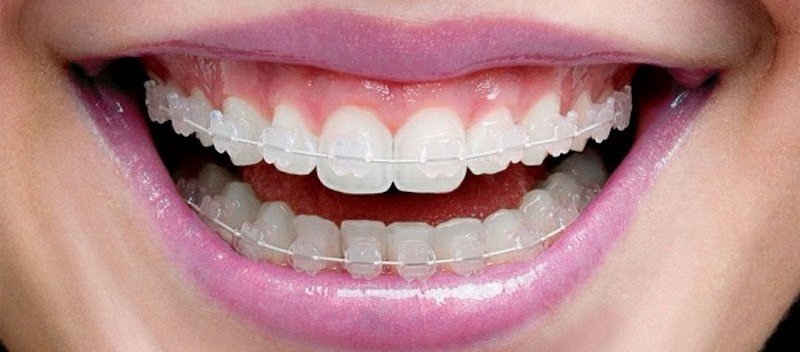 DRA ROSANGELA F. UMEKITA MIYASAWA | ESPECIALISTA EM ORTODONTIA e HOF| INVISALIGN DOCTOR | DENTISTA CRO60053 - foto 3