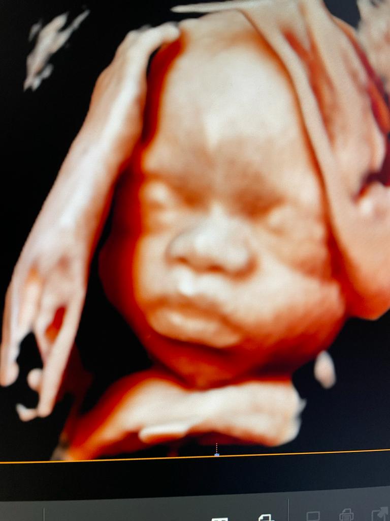 3D-4D Ultrasound Studio Brooklyn
