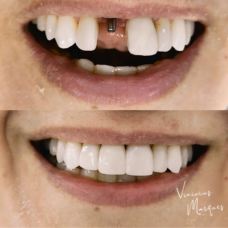Implantes Dentários em Fortaleza - Dr. Vinícius Marques - foto 4