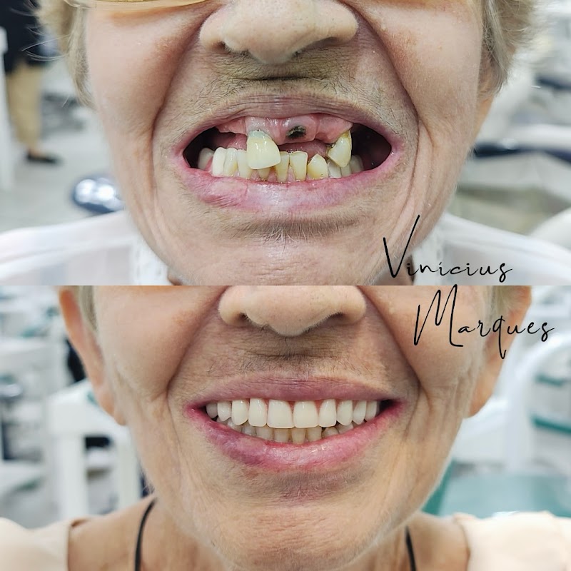 Implantes Dentários em Fortaleza - Dr. Vinícius Marques - foto 5