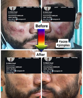 Dermatologist Dr Goyal- Best Skin/Hair specialist Ambala | Trichologist | Child Skin Specialist | Laser Hair Reduction| - Image 2