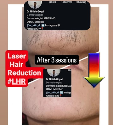 Dermatologist Dr Goyal- Best Skin/Hair specialist Ambala | Trichologist | Child Skin Specialist | Laser Hair Reduction| - Image 3