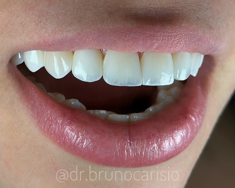 Dentista - Dr. Bruno Carisio - Lentes de Resina e Implantes - foto 1