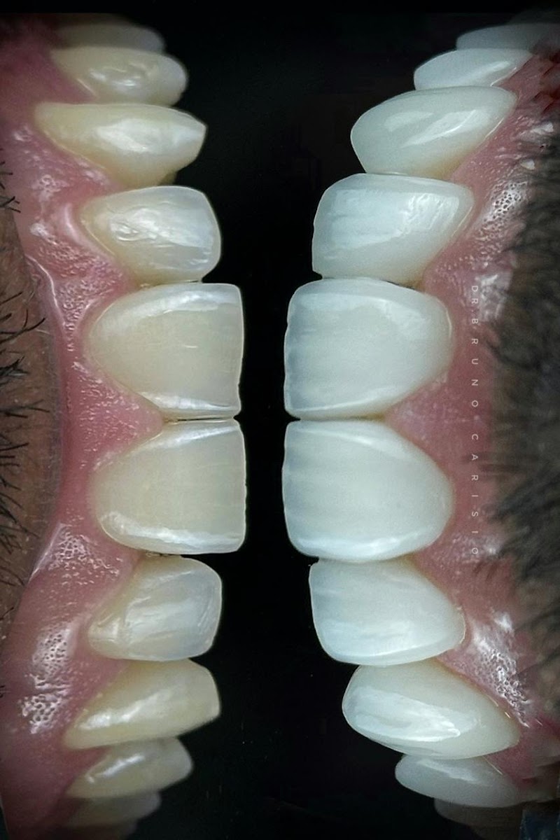 Dentista - Dr. Bruno Carisio - Lentes de Resina e Implantes - foto 4