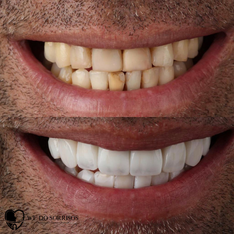 We Do Sorrisos - DENTISTA EM NITERÓI - FACETAS EM RESINA