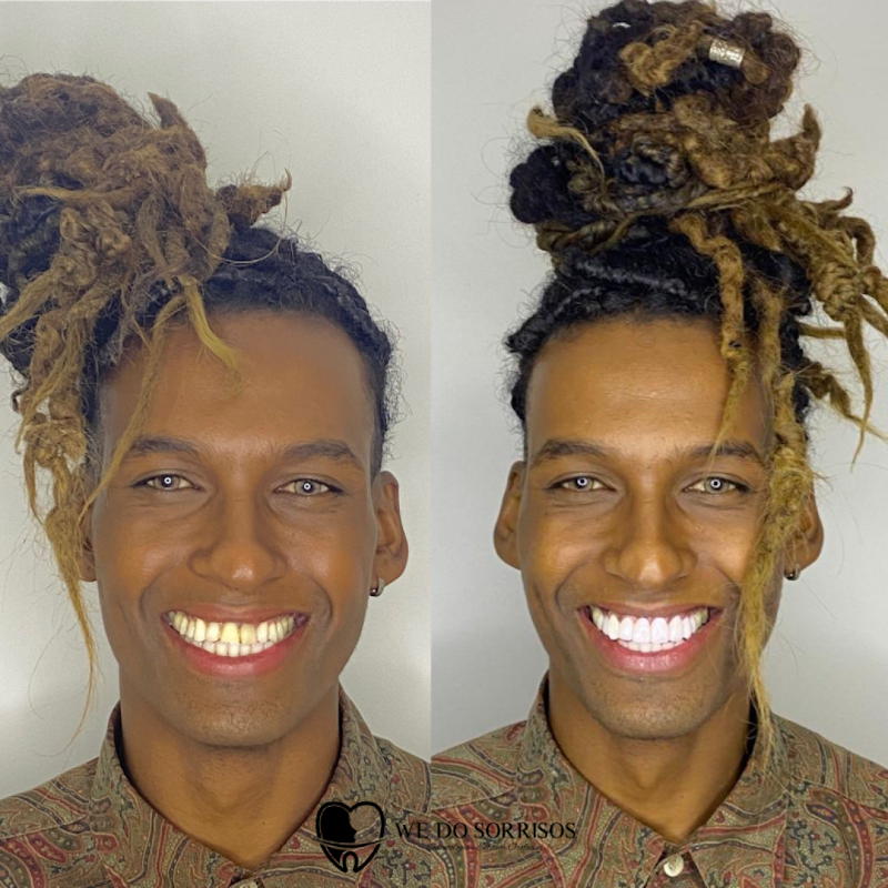 We Do Sorrisos - DENTISTA EM NITERÓI - FACETAS EM RESINA - foto 5