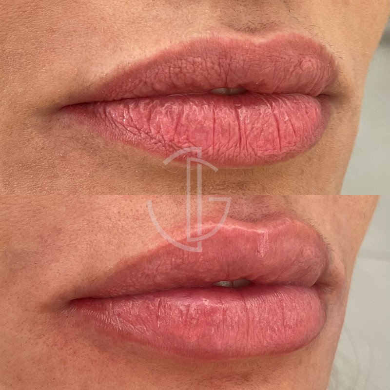 Clínica Juliana Guedes - Facetas de Resina, Lente de Contato Dental e Clareamento | Dentista em Natal RN - foto 5