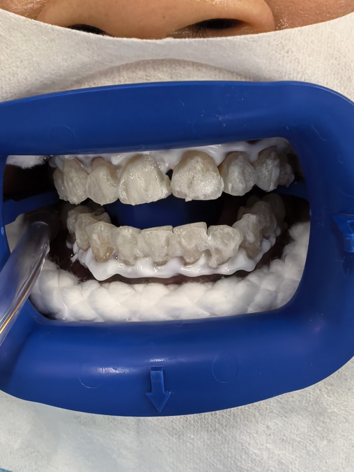 Lumen Smile 4