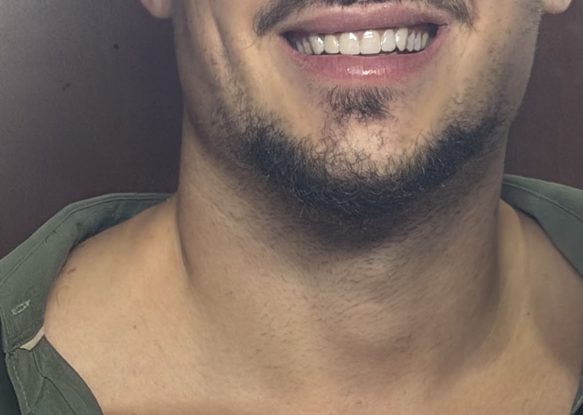 Lumen Smile 3