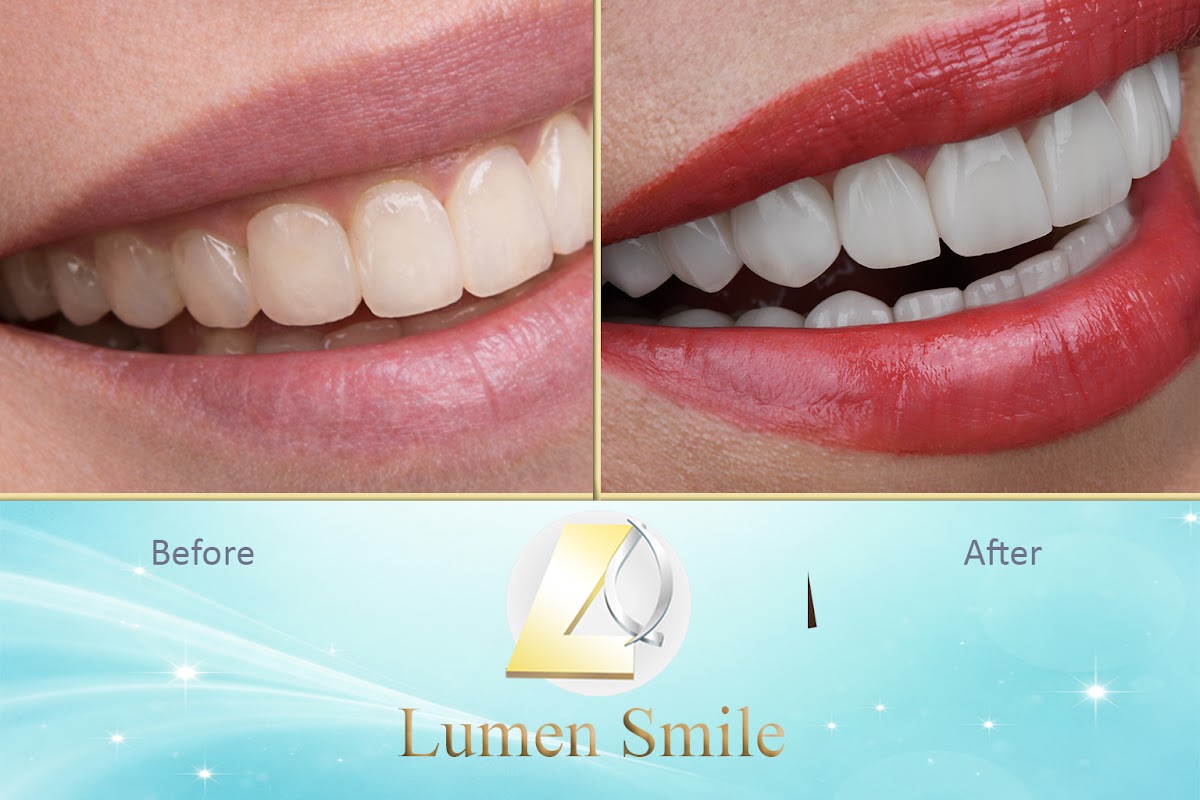 Lumen Smile