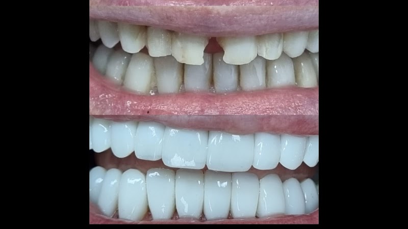 Dentista Dr. Cesar Ferraz / Lentes de Resina e Porcelana / Brasilia-DF - foto 5