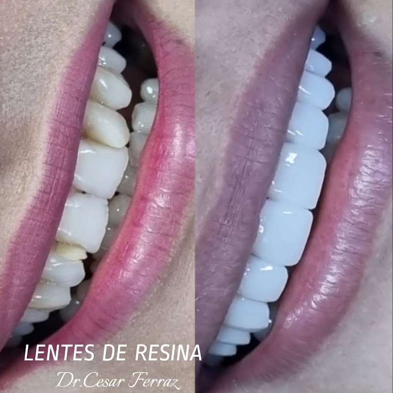 Dentista Dr. Cesar Ferraz / Lentes de Resina e Porcelana / Brasilia-DF - foto 2